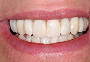 Bay Shore Before and After Dental Implants