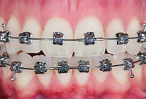 Bay Shore Before and After Teeth Whitening