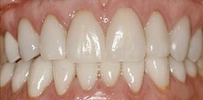 Before and After Dental Braces in Bay Shore
